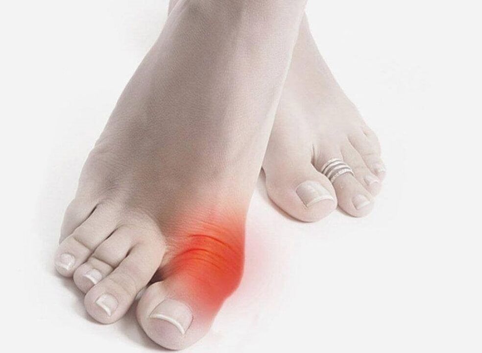 симптоми на подагра в краката